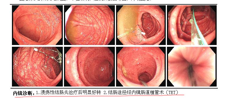 探索溃疡性结肠炎前沿治疗方案